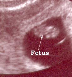6 weeks fetus