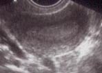 Premenstrual sonar appearance
