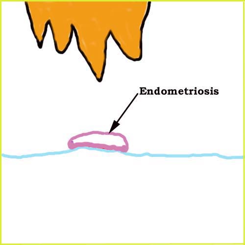 Where can you find a graphical depiction of endometriosis?