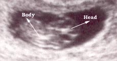 9 weeks fetus