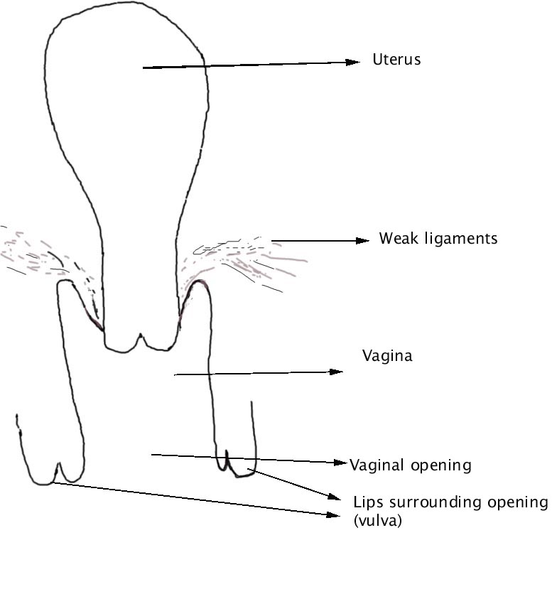  prolapse of the vagina and uterus illustrated