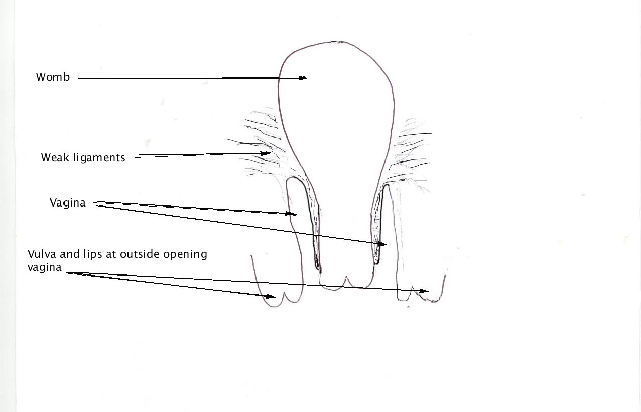 Total prolapse female organs