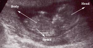 12 weeks fetus